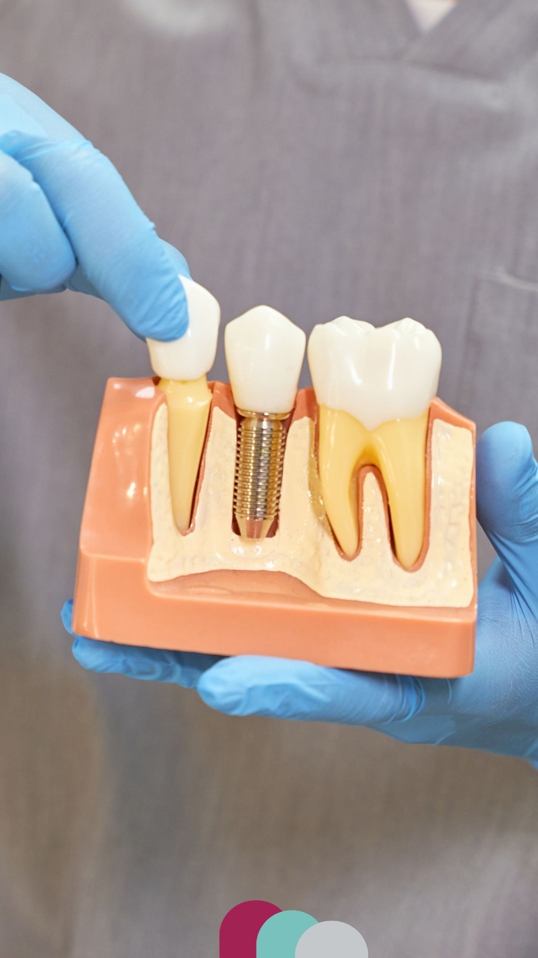 implants in corby