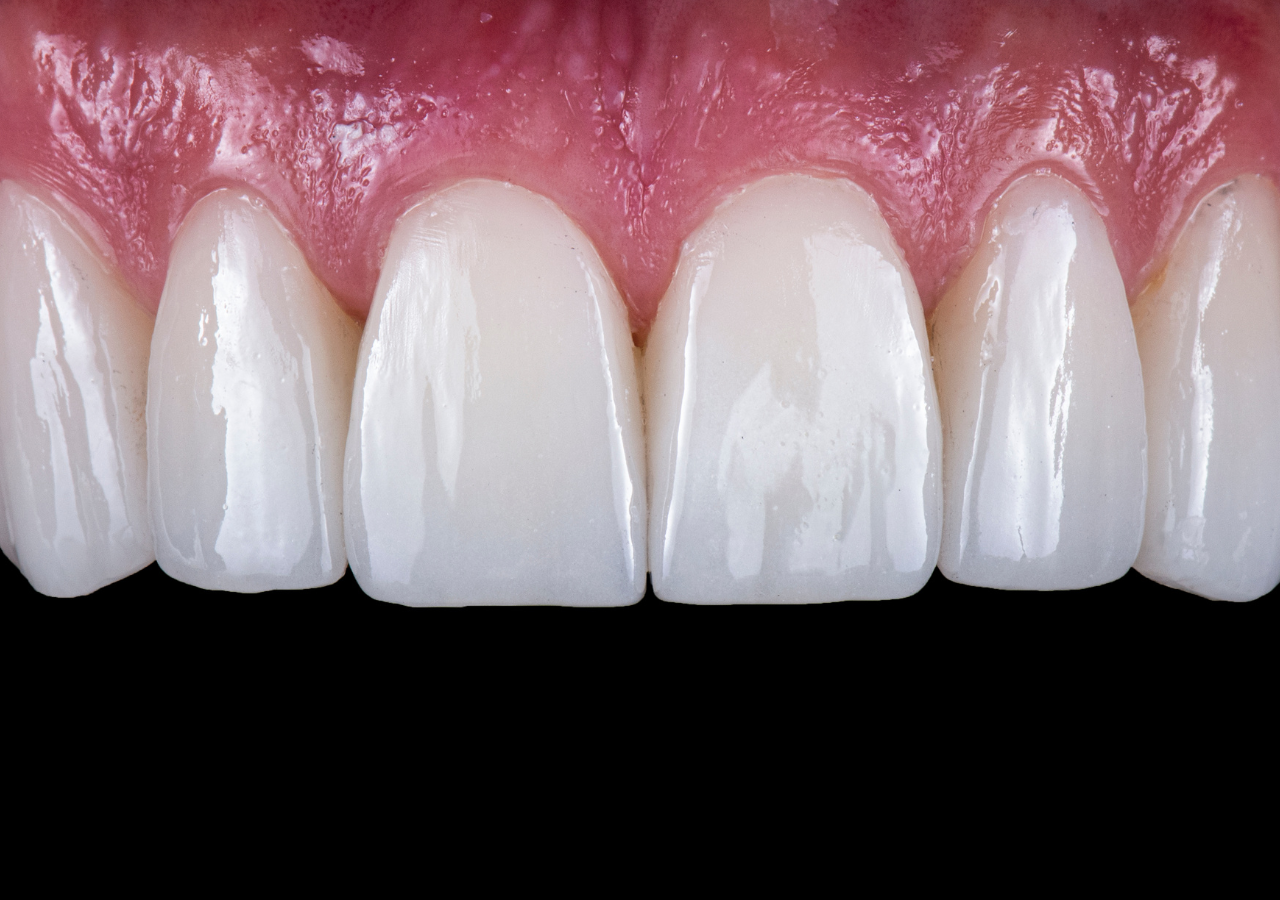 veneers